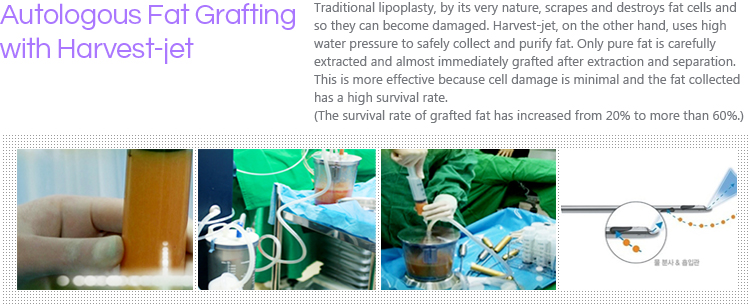 Autologous Fat Grafting with Harvest-jet