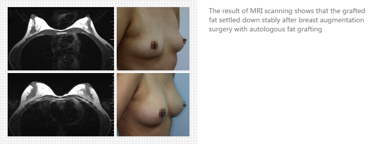The result of MRI scanning shows that the grafted fat settled down stably after breast augmentation surgery with autologous fat grafting