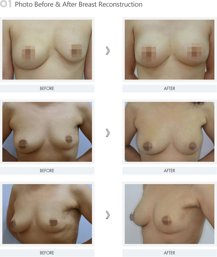  Photo Before & After Breast Reconstruction picture