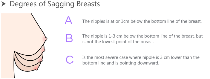 Degrees of Sagging Breasts
