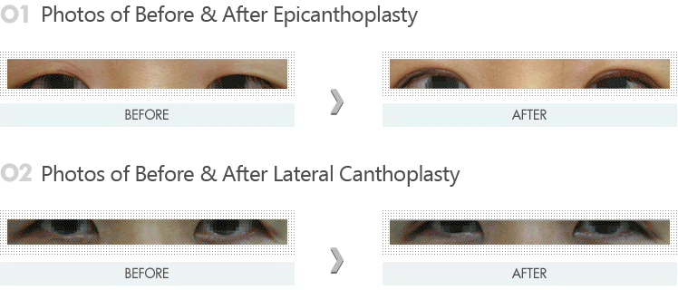 Epicanthoplasty / Lateral Canthoplasty术 PICTURE  
